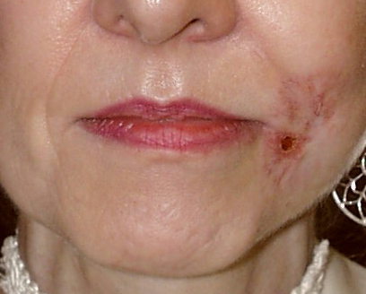 Skin Cancer Mouth